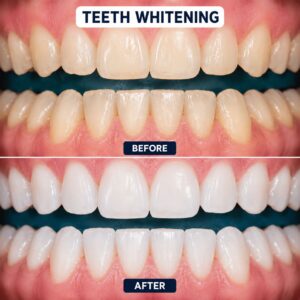 Teeth Whitening