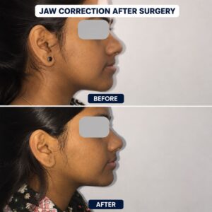 Jaw correction after surgery