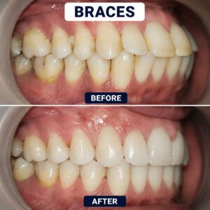 Braces - Before & After treatment
