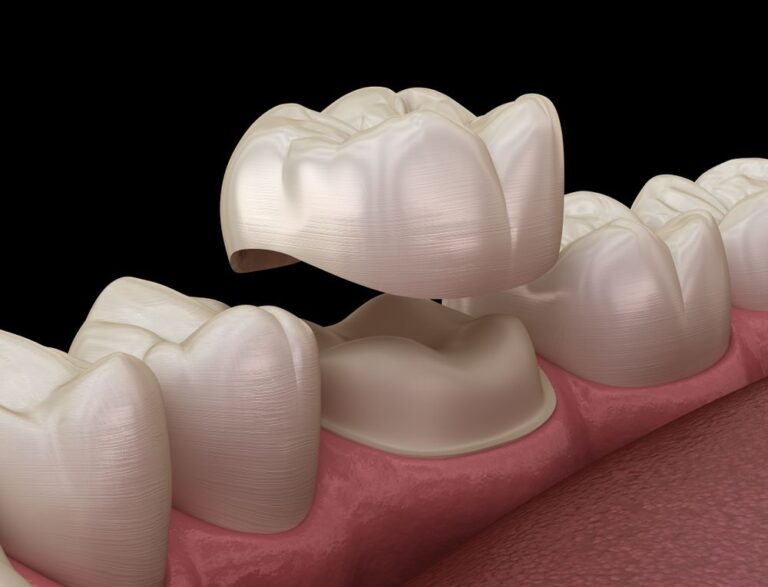 dental crowns and bridges