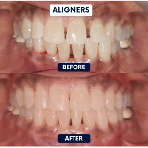 Aligners - before & after