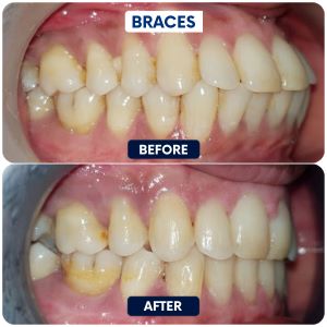 Braces - before & after