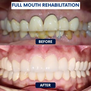 Full mouth rehabilitation - before & after