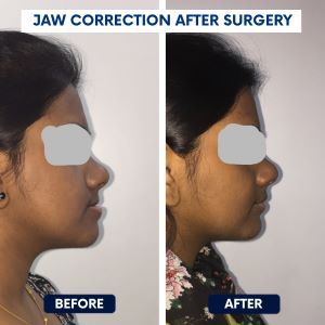 Jaw correction after surgery - before & after
