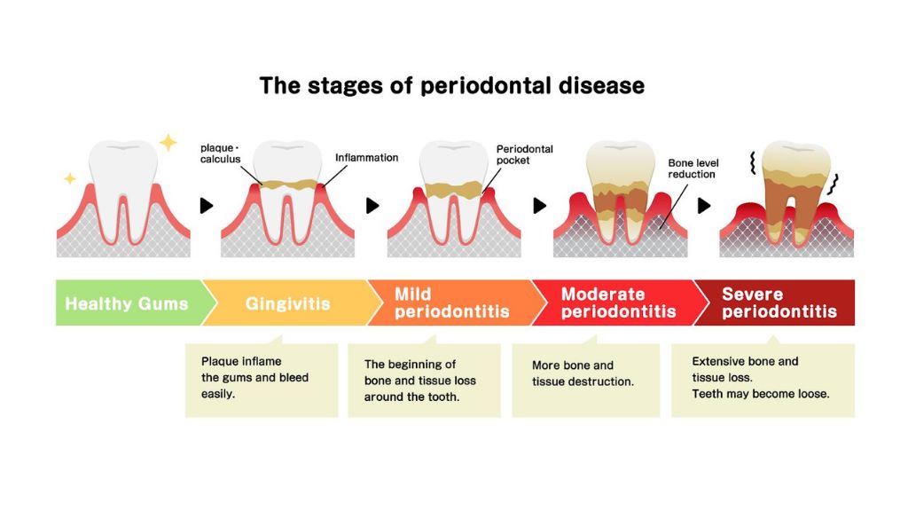 gum treatment
