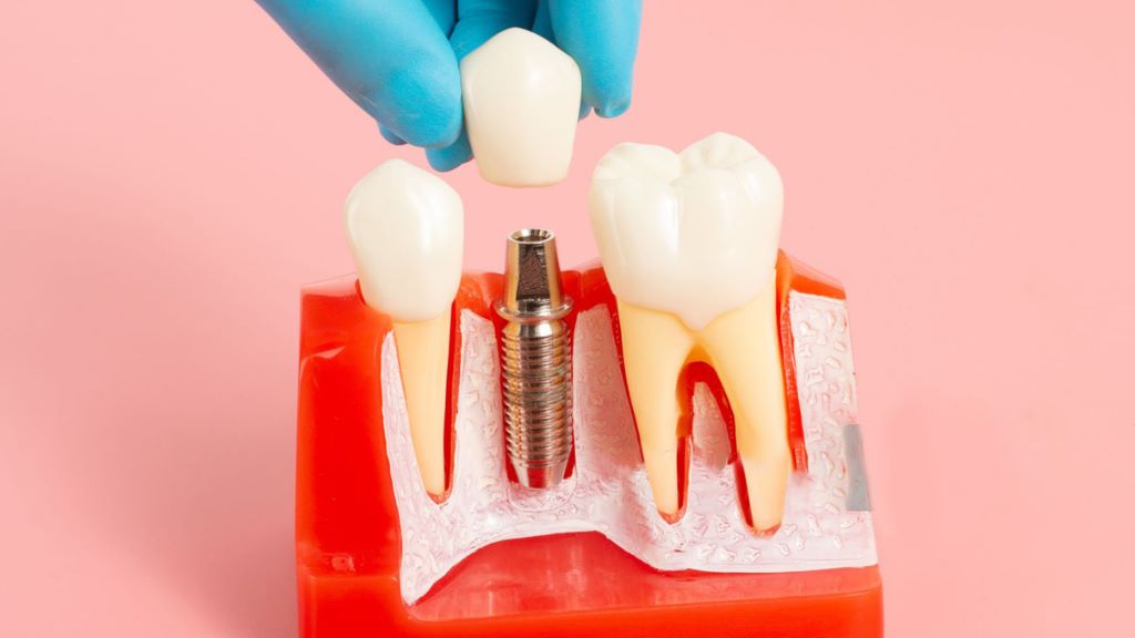 dental implants