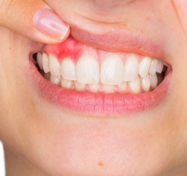 gum treatment
